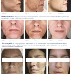 iS Clinical Prodigy Peel Results