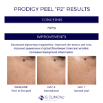 iS Clinical Prodigy Peel Results