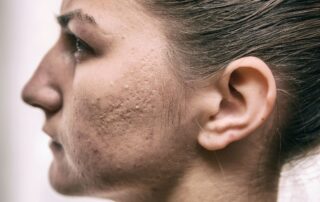 How to improve acne scarring