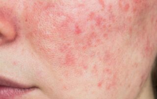 What is Rosacea