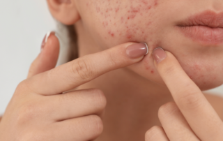 Understanding Acne Part 1 A Deep Dive Into Skin Health (2)