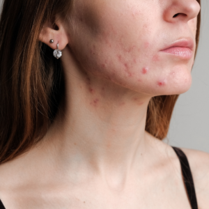 Understanding Acne Part 2 What are the Different Types of Acne How do you treat Acne (2) Understanding Acne Part 2 What are the Different Types of Acne How do you treat Acne (2)