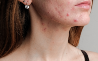 Understanding Acne Part 2 What are the Different Types of Acne How do you treat Acne