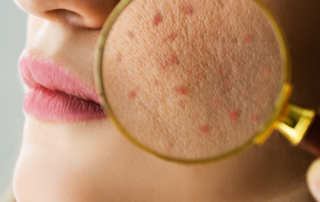 Acne Prone Skin
