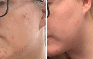 pH Formula Skin Resurfacing Treatments