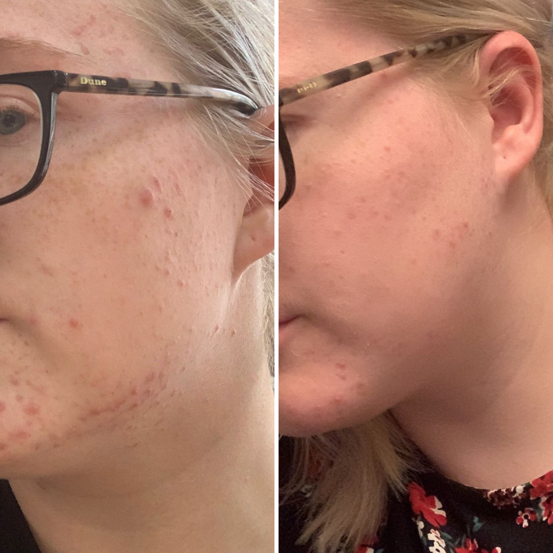 pH Formula Skin Resurfacing Treatments 